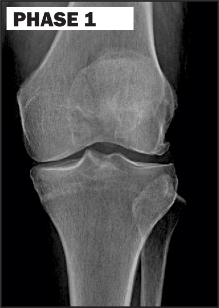 Chiropractic La Porte IN Knee Degeneration Phase 1
