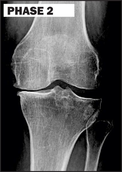 Chiropractic La Porte IN Knee Degeneration Phase 2