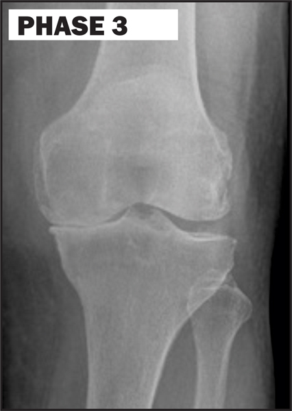 Chiropractic La Porte IN Knee Degeneration Phase 3